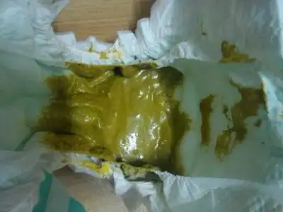 宝宝五十天,四五天才一次大便,很臭,黄绿色,怎麼回事