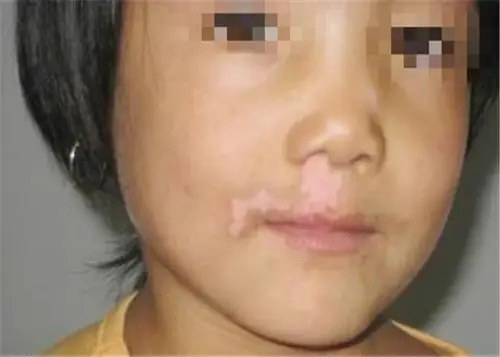 花斑癣头部脱毛症状图片