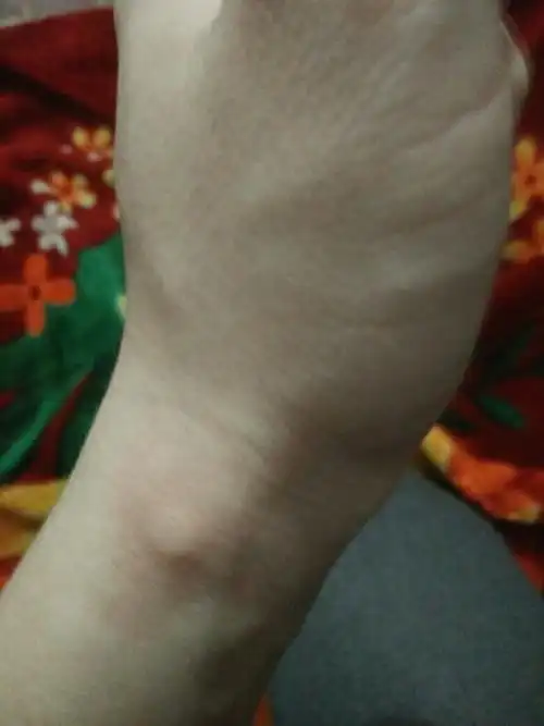 手腕处起了一个包