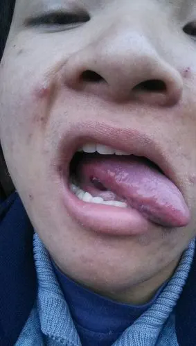 吃饭时,舌头下突然长了颗血泡,呈黑紫色,而且越来越