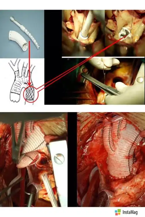 兰州大学第一医院心血管外科