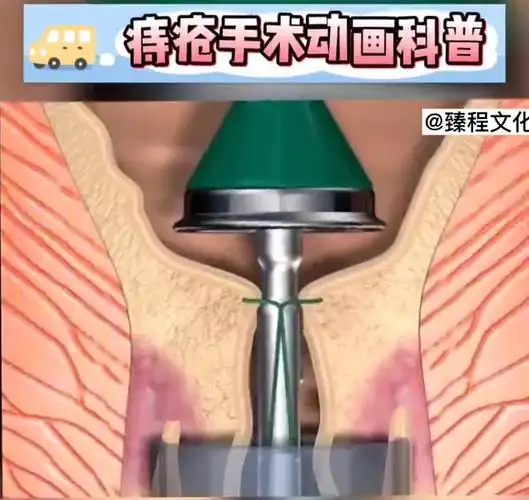 痔疮手术动画演示了解一下