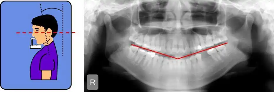 伯爵cbct影像篇③口腔全景片认知