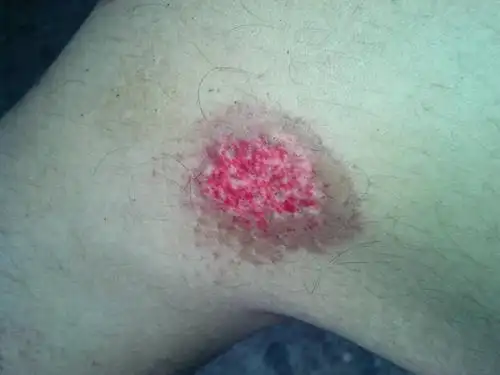 问:被车撞后膝盖左侧血斑变大有没有事