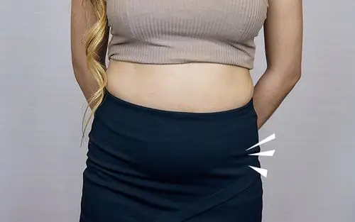 冷冻减脂 酷思塑平 coolsculpting 瘦肚子术前肥嘟嘟的