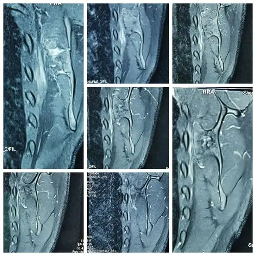 术前mri检查结果提示:肩胛骨良性肿瘤可能性大.