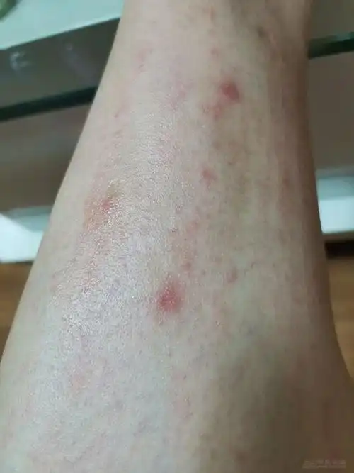 季节性皮炎如期而至