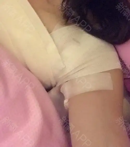 南昌假体隆胸好不好_效果图_真切感受假体隆胸术后第2天_新氧美容整形