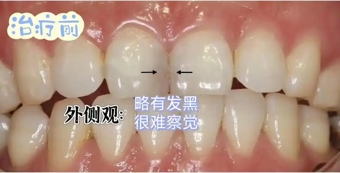 有些牙齿总是会蛀得与众不同像这种邻面龋是最不容易被察觉的而且一坏