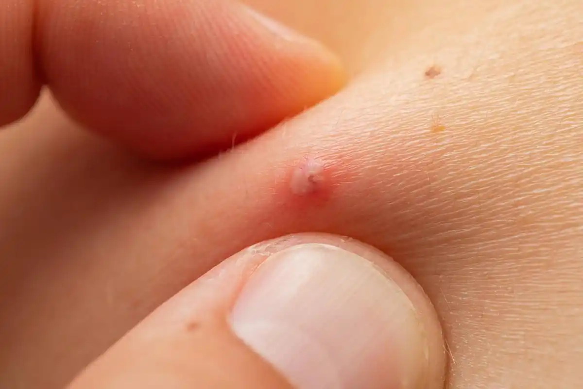 身上起红色疙瘩很痒怎么回事?营养师来解答!