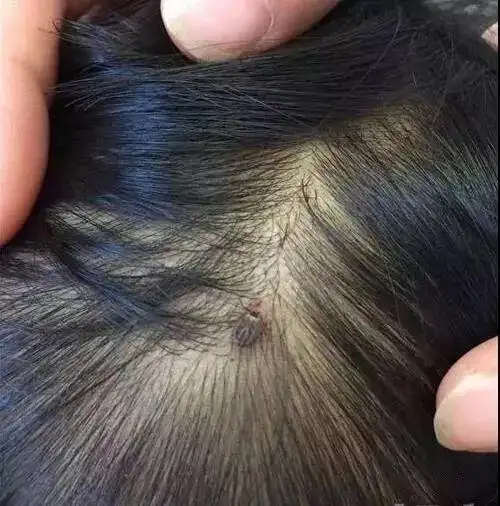 5岁女孩被虫咬瘫痪夏季要提防这些虫子