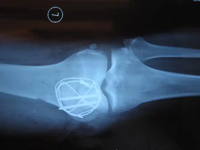 征集髌骨骨折x光片按要求提供给予积分