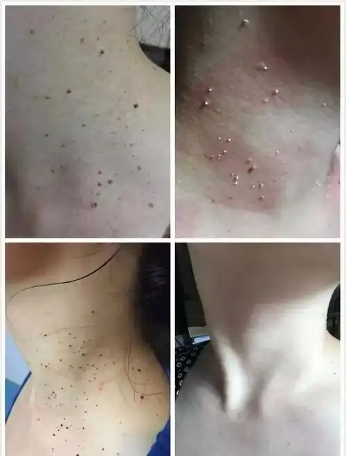 湿寒过重,经络不通,新陈代谢不好,排毒不畅!免疫力下降!易长扁平疣!