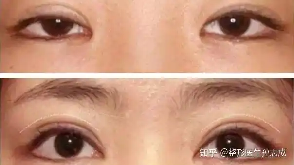 很多人内眼角形状比较圆钝,甚至完全看不到那块粉红色的肉肉(泪阜)