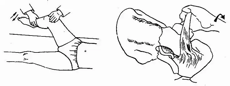 图2-65 闭孔肌征的示意图(4)皮肤感觉过敏区(图2-66):少数病人在急性