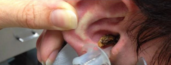 宝宝的耳朵能不能掏, 有耳屎怎么办? 听听儿科医生怎么说!