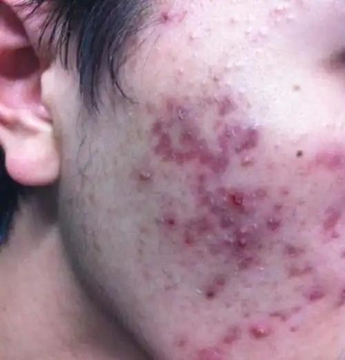 痤疮又名青春痘,实际上痤疮并不是青春的专利,痤疮除了青春期容易形成