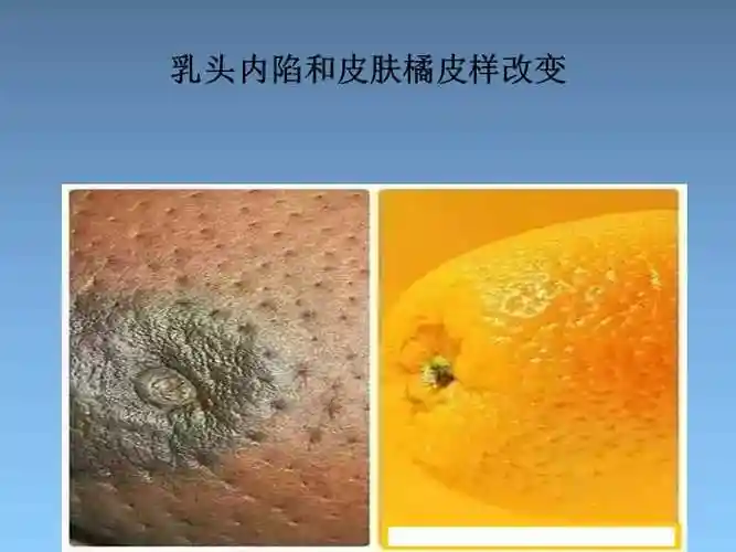 乳腺癌诊疗流程ppt