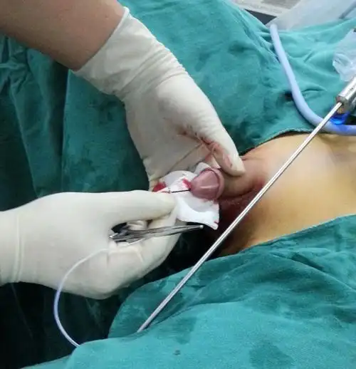 婴儿尿路感染哭闹的图片