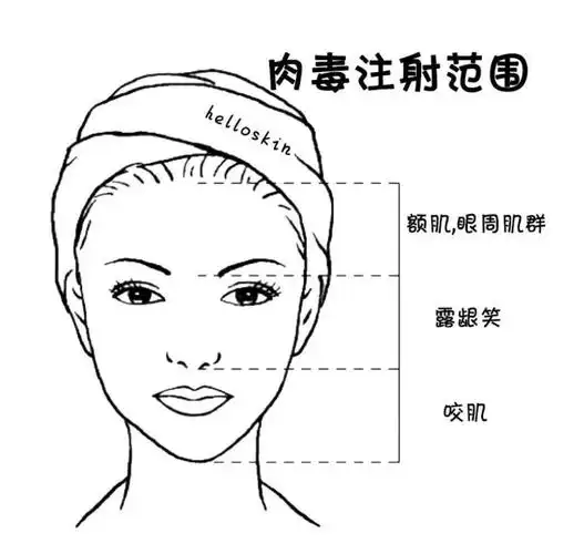 玻尿酸填充肉毒瘦脸真人体验告诉你这些医美项目到底值不值得做