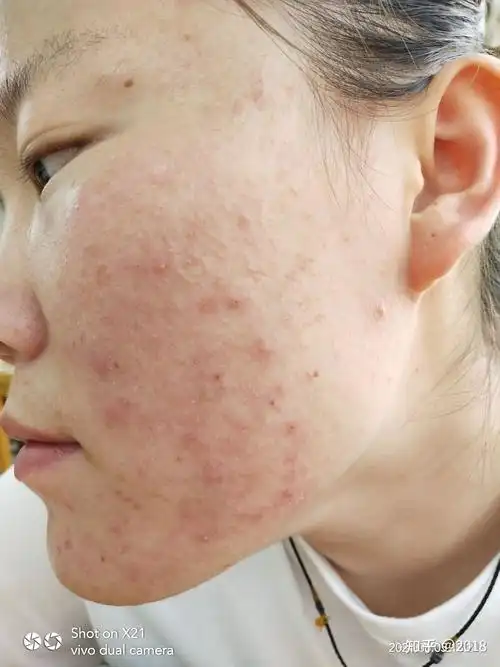 作为一个青春期的学生满脸痘痘一直苦恼着我如何轻松祛痘