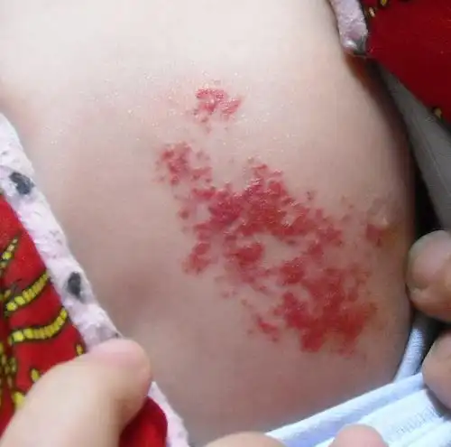 混合型血管瘤是什么样的http://www.piyanshizhen.com