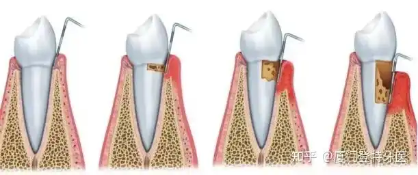 牙槽骨吸收后,还能长回来吗?想做种植牙怎么办? - 知乎