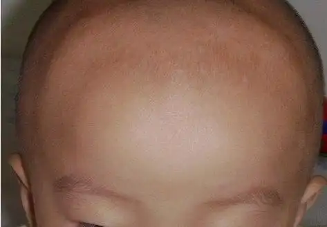 最近发烧,除了体温比较高之外,宝妈发现孩子的囟门也比平时要凸出来