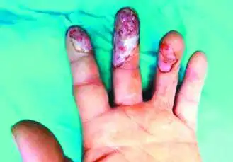 男子回收废品误碰"化骨水" 险截肢(图)