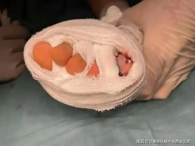 俩脚趾连一起手术成功分离