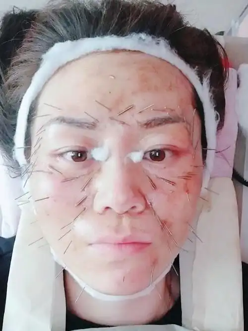 针灸美容了解一下