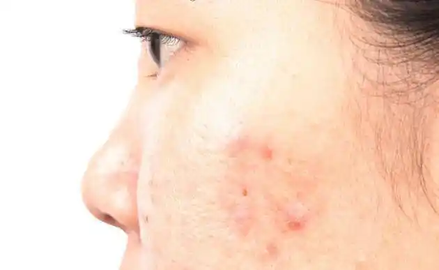 脸上出现"异常",女子不当回事,两个月后确定肝病,化疗数次后终离世