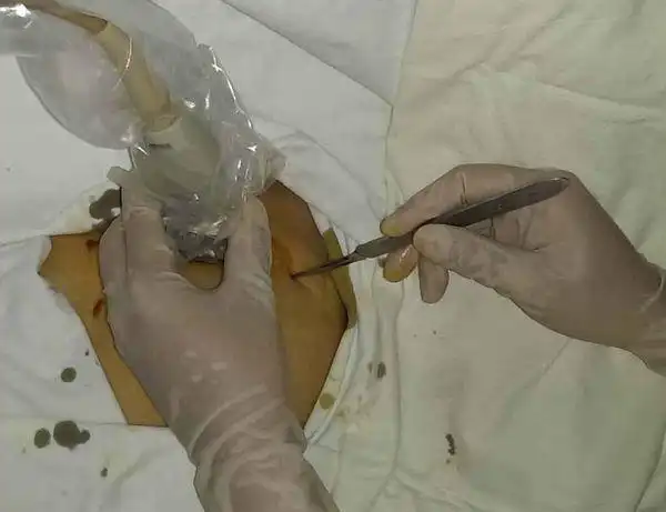 乳房微创手术入院须知 - 好大夫在线