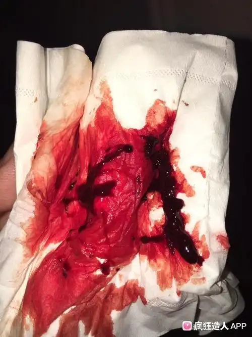 上月打过促排针,吃过天喜丸!有点偏头痛