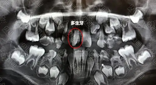 儿童多生牙ct拍摄图片