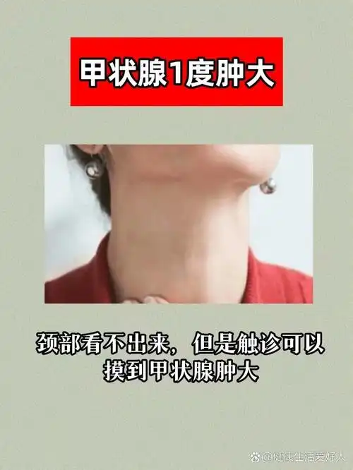 br>甲减 甲亢 结节 桥本甲状腺炎等甲状腺问题都容易引起甲状腺肿大.