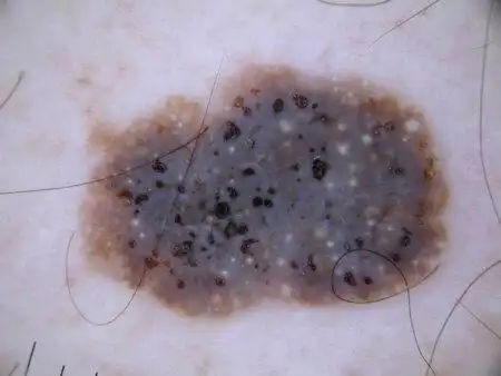 有文献报道文身部位发生脂溢性角化病,与外伤后人类乳头瘤病毒感染有