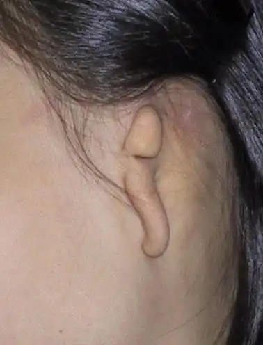 小耳畸形可以分为四种等级: 第一级: 有一只比较小的耳朵,可以看到