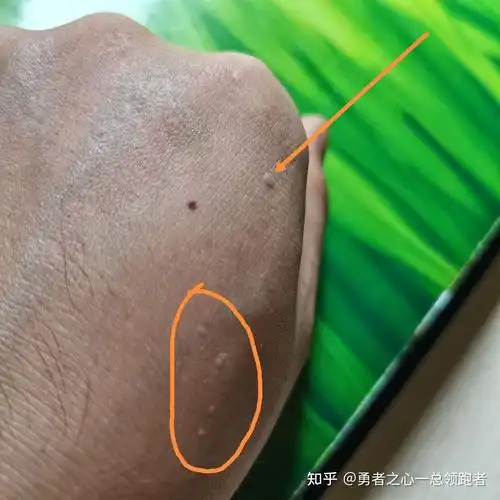 手背上长小疙瘩不疼不痒很长时间是什么