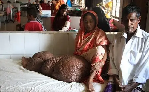 孟加拉女子腿部增生重达60公斤疑患象皮病