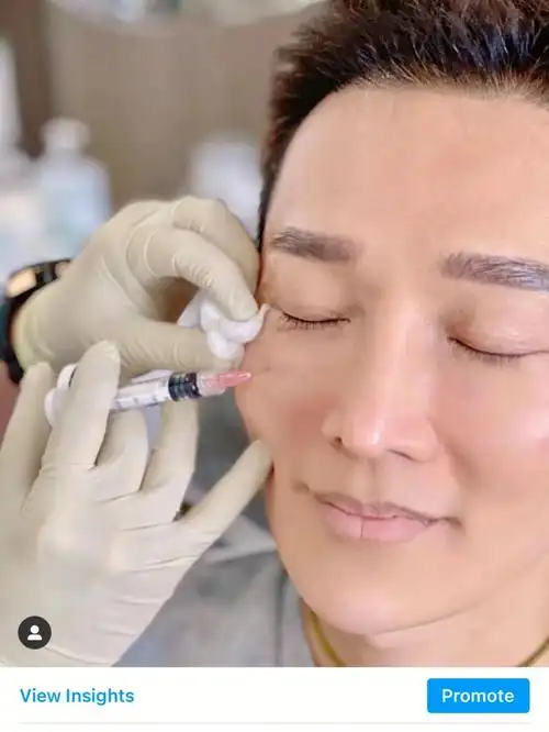 profhilo 瑞士5点提升针,逆龄针今天来和大家聊一聊最近非常火的瑞士