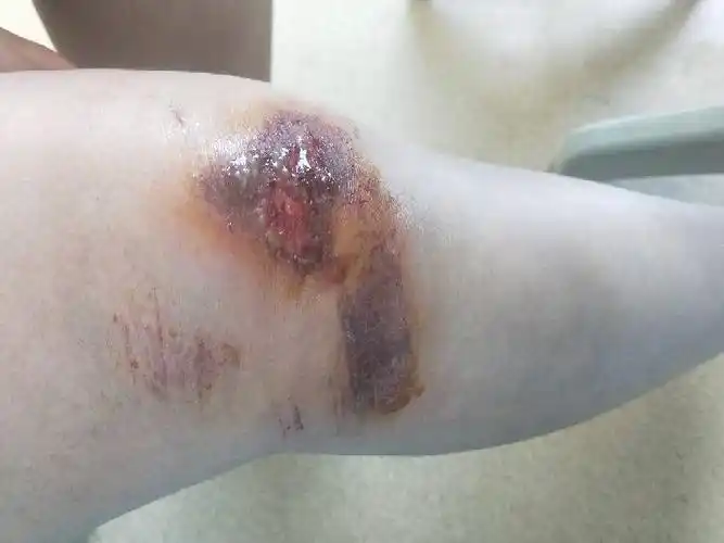 腿受伤了,特别的疼摸什么药管用可以不让他疼