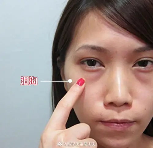 泪沟严重时,会一直从眼角延伸到中面部
