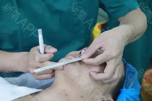 大家好我现在给大家分享一个我在北京悦丽汇做的鼻基底填充的手术吧