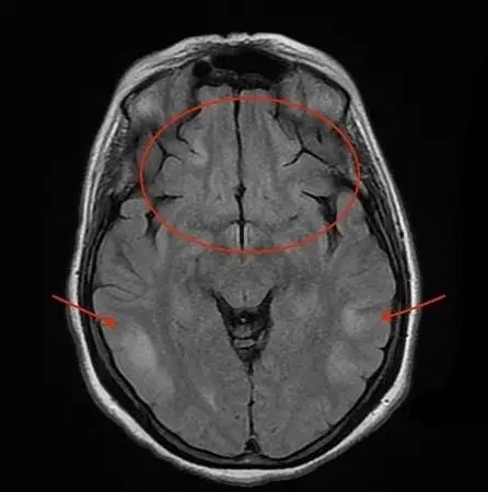 flair 示双侧额叶内侧,岛叶皮层(圈示)和颞叶后部(箭头)