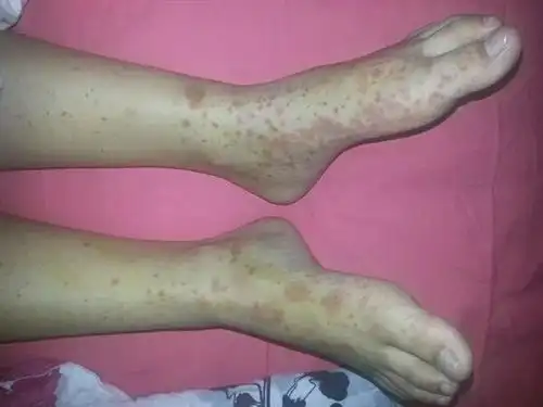 荨麻疹性血管炎怎么治?