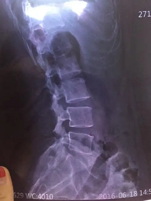 腰右侧脊椎小骨有点错位闪了腰,去医院让医生拿了拿,开了点药,回来