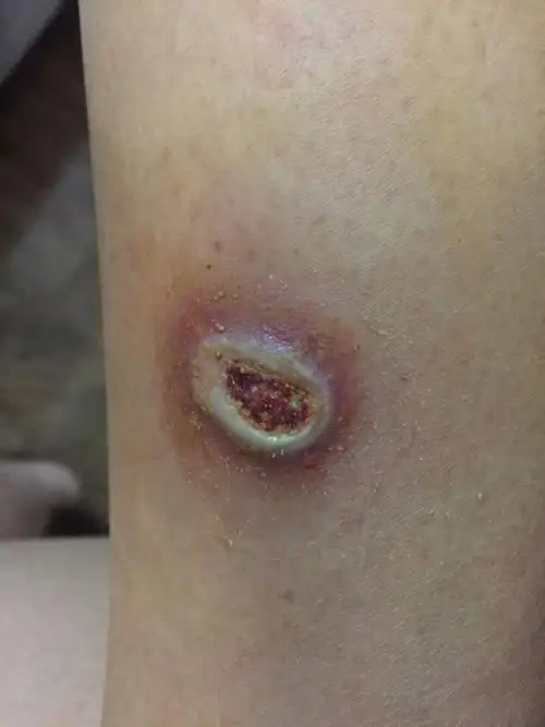 请问这样的烫伤伤口是在愈合当中吗,还要多久才能愈合好?