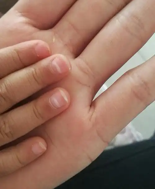 宝宝指甲有白斑,是缺钙还是蛔虫在作怪?医生:只需警惕一种情况