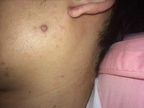 问:脸上长了这个包,不痛不痒,怕黑色素瘤.不知道是不是.